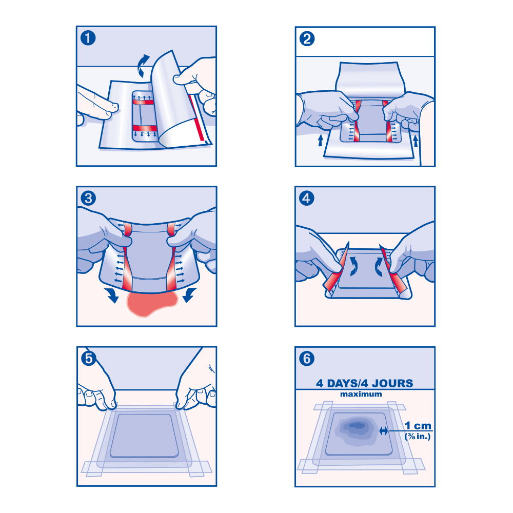 Immagine della procedura di applicazione di Cutimed® Sorbact® Hydroactive Immagine della procedura di applicazione di Cutimed® Sorbact® Hydroactive